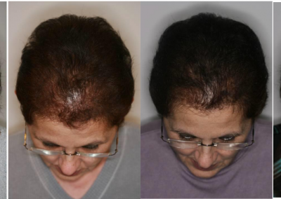 Alopecia Mujer