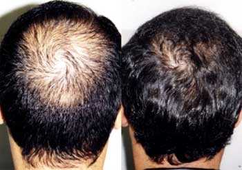 Alopecia Hombre