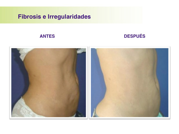 Prevención de fibrosis en una abdominoplastia