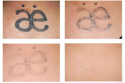 4 sesiones Borrado de tatuajes 23 x17cm