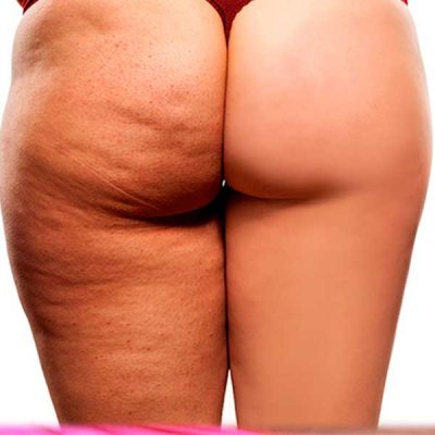 Celulitis 8 sesiones