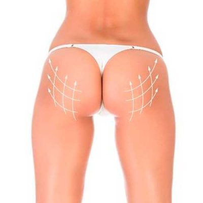 8 sesiones carboxiterapia 1 zona+12 sesiones levantamiento de glúteos+2 sesiones plasma gel de glúteos+ 1 sesión ADN de salmón