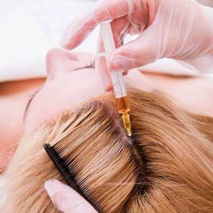 Mesoterapia para caída de pelo