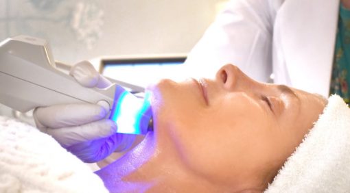 5 Sesiones de exilis facial