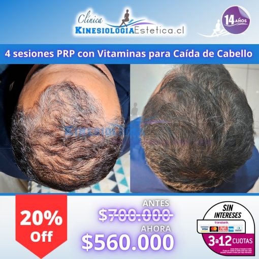 4 ses. PRP con vitaminas para caída de cabello