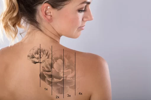 4 sesiones de borrado de tatuajes 14x6