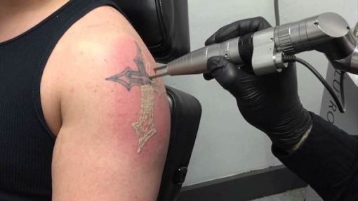 4 sesiones Borrado de tatuaje 3x3