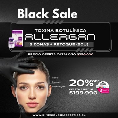 Botox 3 Zonas + Retoque (50U)