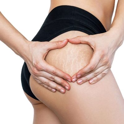 4 sesiones tratamiento  estrías  2 cuadrantes